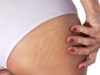 What Causes Stretch Marks On The Thighs How To Remove Stretch Marks On Thighs