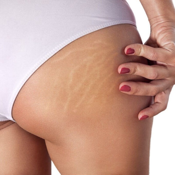 How To Remove Stretch Marks On Thighs How To Remove Stretch Marks On Thighs