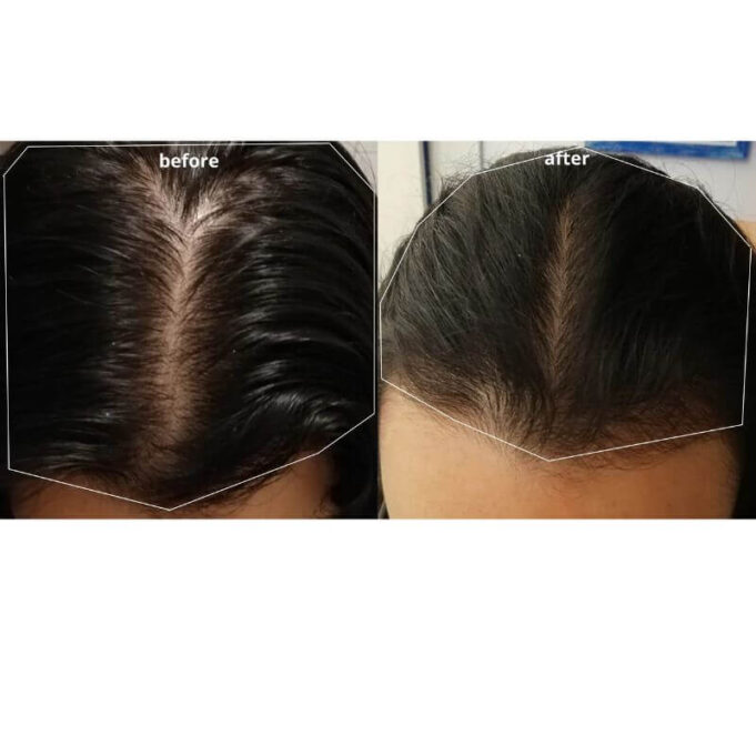 What Causes Hair Breakage? What Causes Hair Breakage?