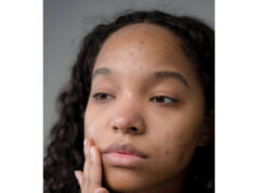Does Sex Help With Acne Does Sex Help With Acne