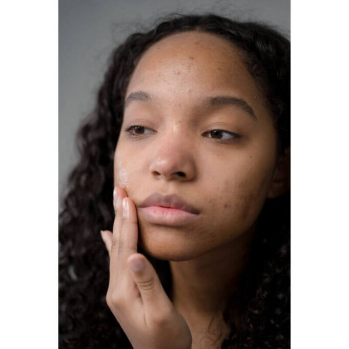 Does Sex Help With Acne Does Sex Help With Acne