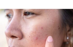 Face Breaking Out. What Should I Do? Face Breaking Out