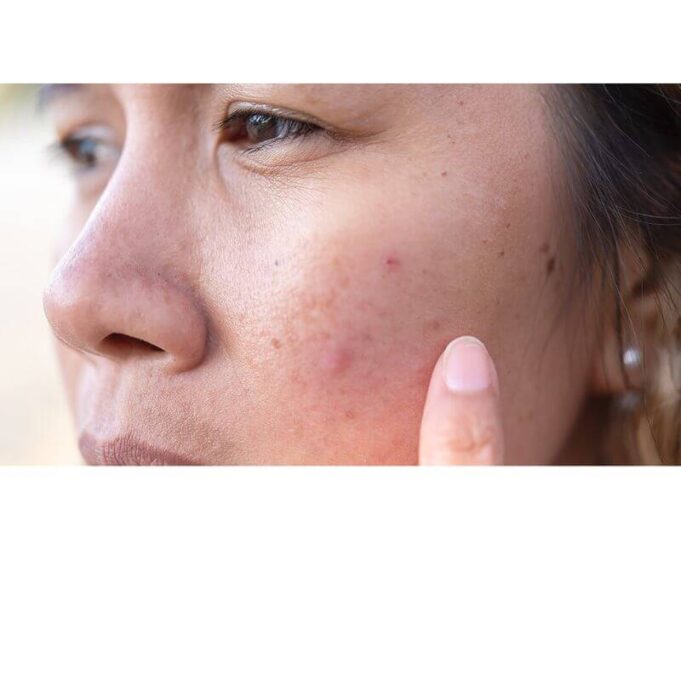 Face Breaking Out. What Should I Do? Face Breaking Out
