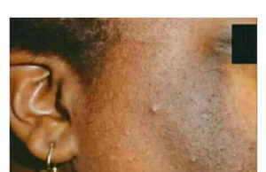 How To Remove Sunburn From Face Quickly How To Remove Sunburn From Face