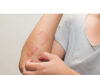 Is Atopic Dermatitis Always Itchy? Is Atopic Dermatitis Always Itchy?
