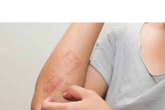Is Atopic Dermatitis Always Itchy? Is Atopic Dermatitis Always Itchy?