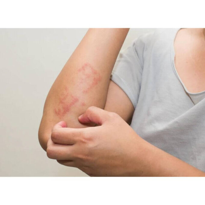 Is Atopic Dermatitis Always Itchy? Is Atopic Dermatitis Always Itchy?
