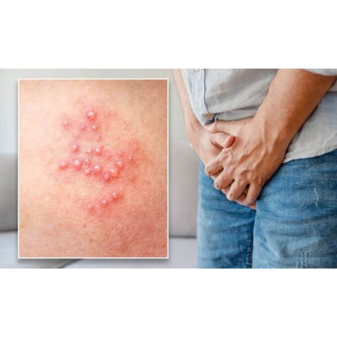 Itchy Pimples On The Penile Head. Causes And Remedies Itchy Pimples On The Penile Head. Causes And Remedies