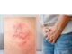 Itchy Pimples On The Penile Head. Causes And Remedies Itchy Pimples On The Penile Head. Causes And Remedies