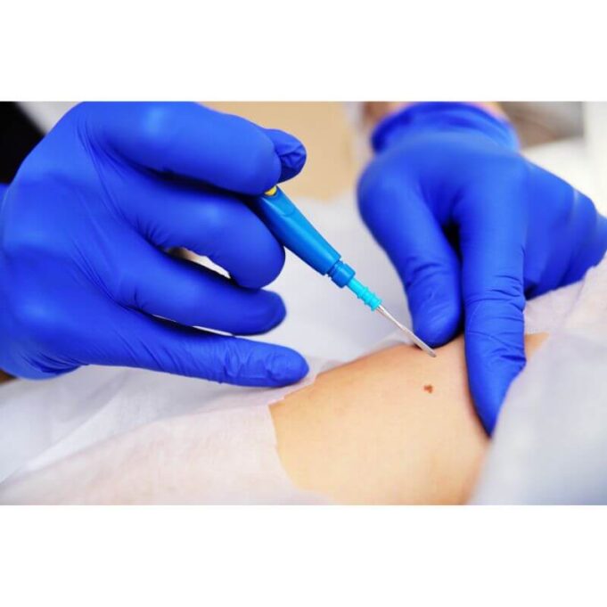 How Long Should You Keep a Skin Biopsy Covered How Long Should You Keep a Skin Biopsy Covered