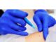 How Long Should You Keep a Skin Biopsy Covered How Long Should You Keep a Skin Biopsy Covered