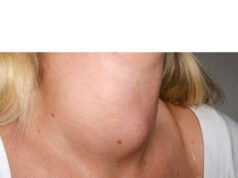 How to Shrink a Goiter Naturally. Possible? How to Shrink a Goiter Naturally. Possible?