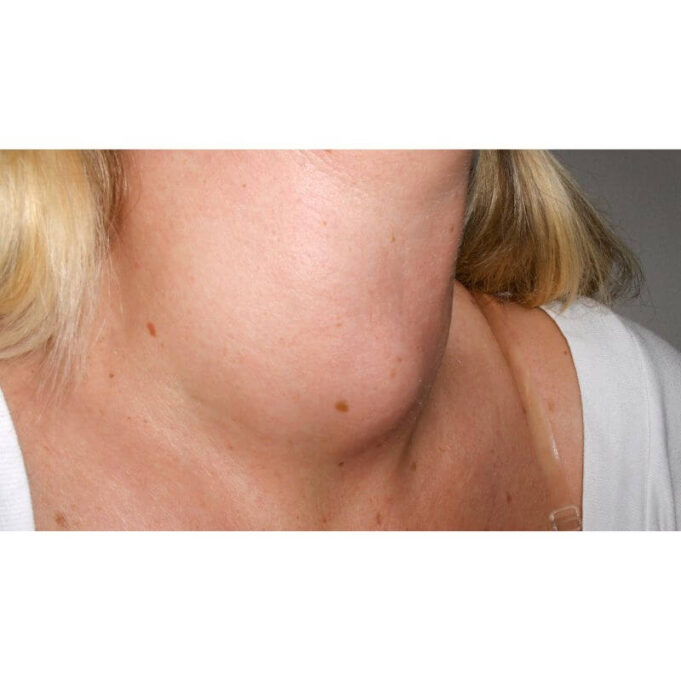 How to Shrink a Goiter Naturally. Possible? How to Shrink a Goiter Naturally. Possible?