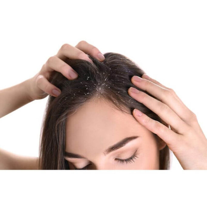 How to Treat Dandruff Naturally How to Treat Dandruff Naturally