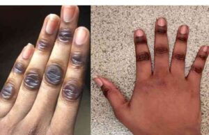 What Causes Dark Knuckles What Causes Dark Knuckles