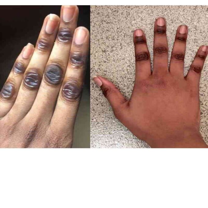 What Causes Dark Knuckles What Causes Dark Knuckles