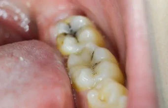 How to Stop a Cavity from Getting Worse Stop a Cavity from Getting Worse