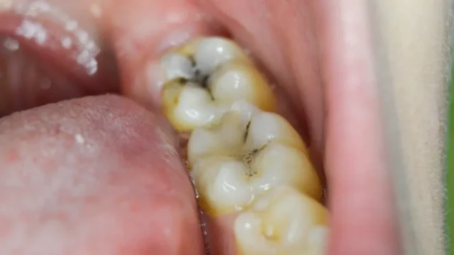 Stop a Cavity from Getting Worse Stop a Cavity from Getting Worse