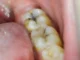 How to Stop a Cavity from Getting Worse Stop a Cavity from Getting Worse
