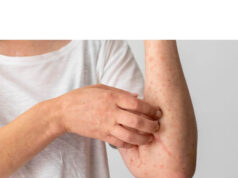 Can Bleach Treat Fungal Skin Infections? Can Bleach Treat Fungal Skin Infections?