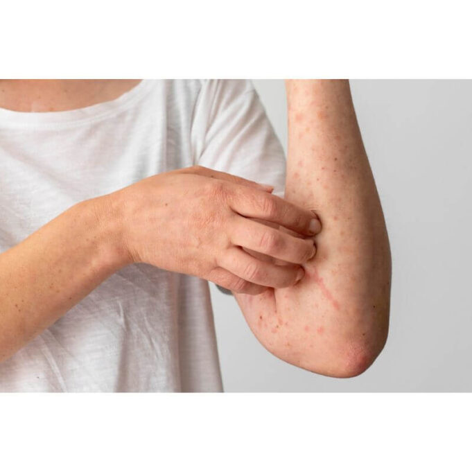 Can Bleach Treat Fungal Skin Infections? Can Bleach Treat Fungal Skin Infections?