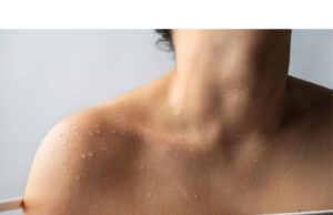 Hives On Skin, what Should I Do? Hives On Skin, what Should I Do?