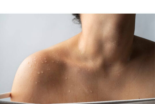 Hives On Skin, what Should I Do? Hives On Skin, what Should I Do?