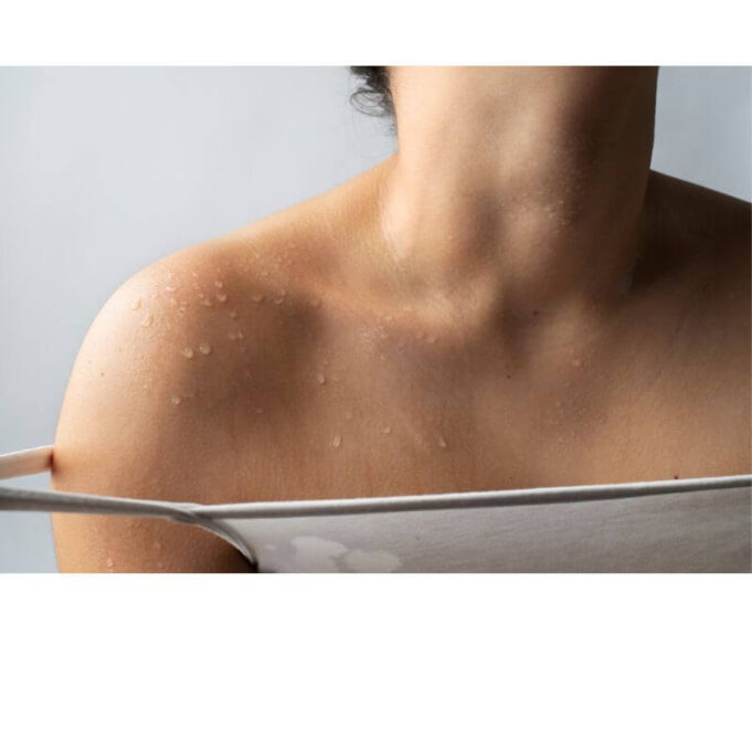 Hives On Skin, what Should I Do? Hives On Skin, what Should I Do?