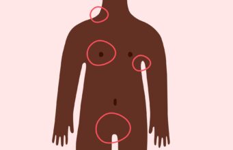 When Not to Worry about a Lump Under your Skin