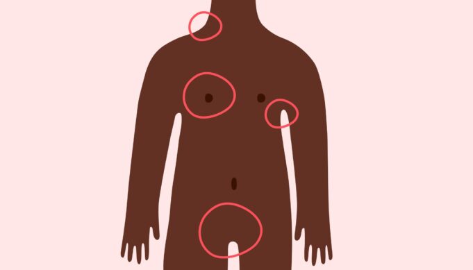 When Not to Worry about a Lump Under your Skin