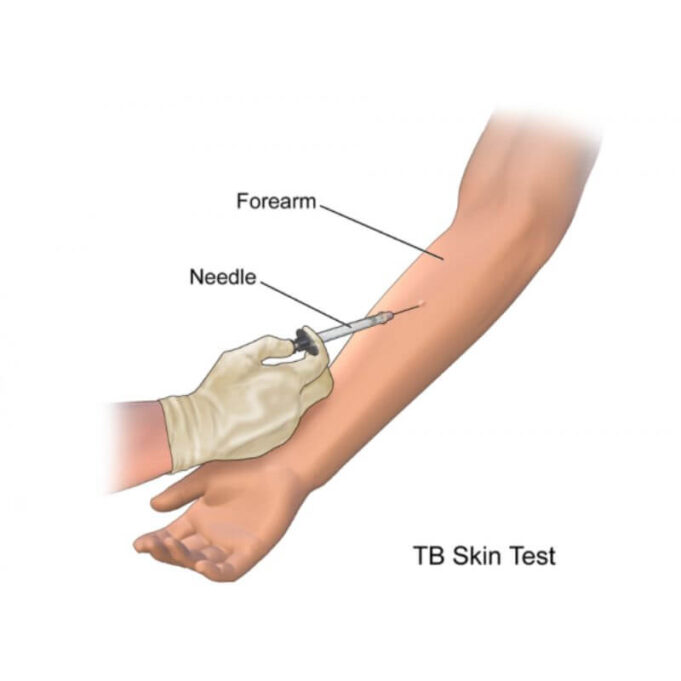 Tuberlin Skin Test Procedure Tuberlin Skin Test Procedure
