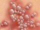 Vaginal Herpes, All You Need To Know About Vaginal Herpes