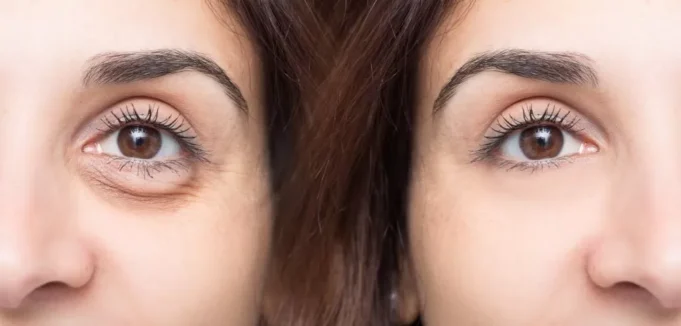 Eye Bags Prevention And Treatment Eye Bags Prevention And Treatment