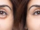 Eye Bags Prevention And Treatment Eye Bags Prevention And Treatment
