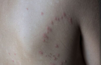 Bed Bugs on Dark Skin Bed Bugs on Dark Skin
