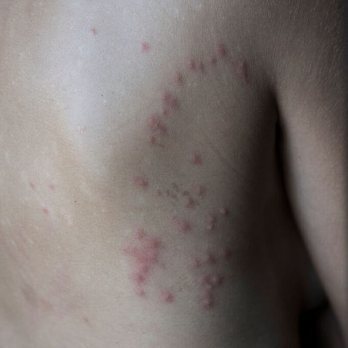 Bed Bugs on Dark Skin Bed Bugs on Dark Skin