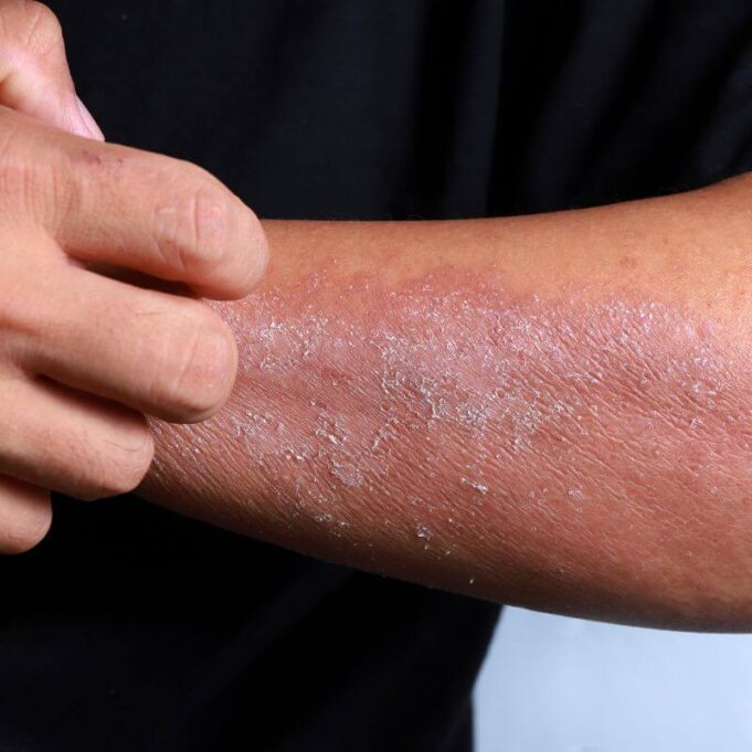 Eczema on Black Skin: What You Should Do Eczema on Black Skin: What You Should Do