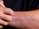 Eczema on Black Skin: What You Should Do Eczema on Black Skin: What You Should Do