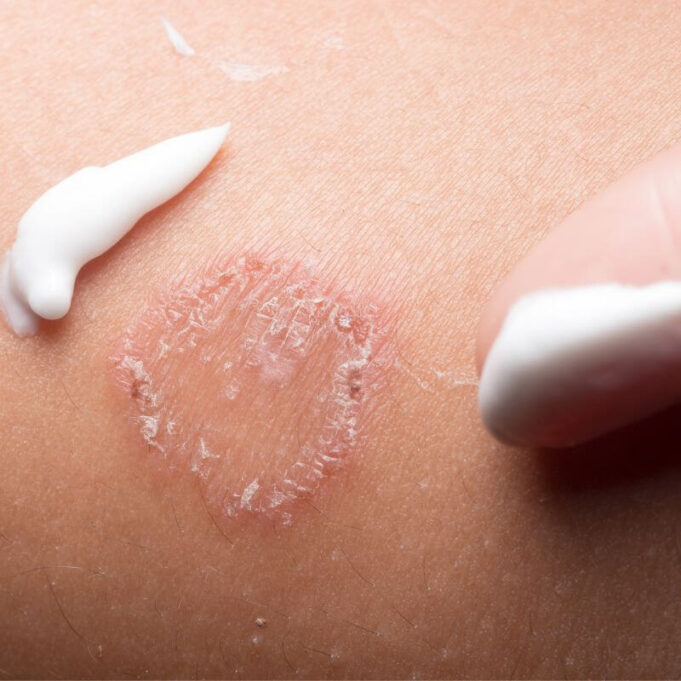 Fluconazole for Skin Infection