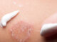 Fluconazole for Skin Infection