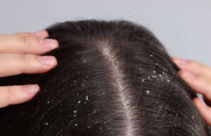 Home Remedies for Dandruff Home Remedies for Dandruff