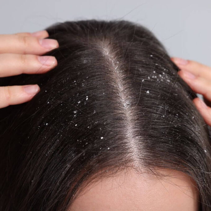 Home Remedies for Dandruff Home Remedies for Dandruff
