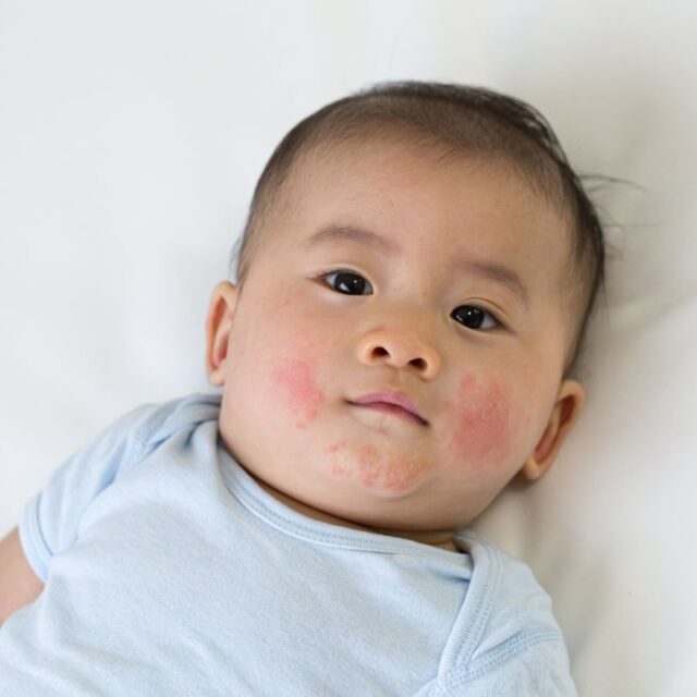 Home Remedies for Baby Rash on Body