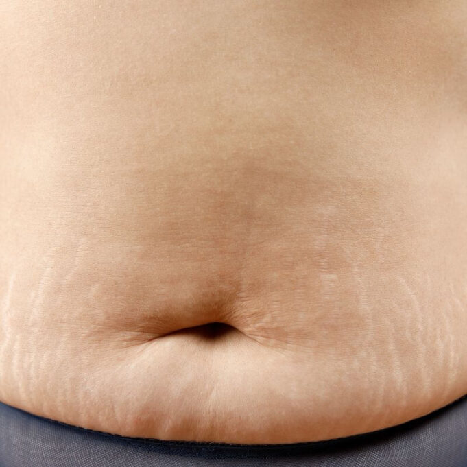 Home Remedies for Stretch Marks Home Remedies for Stretch Marks