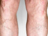 Home Remedies to Remove Varicose Veins Home Remedies to Remove Varicose Veins