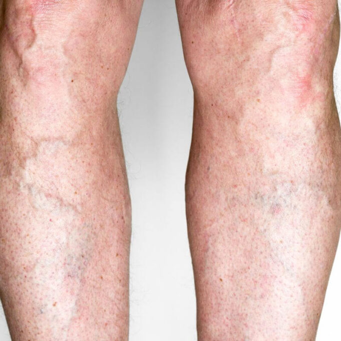 Home Remedies to Remove Varicose Veins Home Remedies to Remove Varicose Veins
