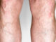 Home Remedies to Remove Varicose Veins Home Remedies to Remove Varicose Veins