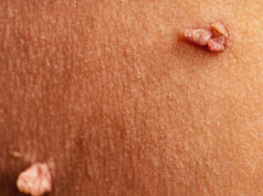 Is There a Skin Tag Removal Toothpaste? Is There a Skin Tag Removal Toothpaste?