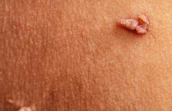 Is There a Skin Tag Removal Toothpaste? Is There a Skin Tag Removal Toothpaste?