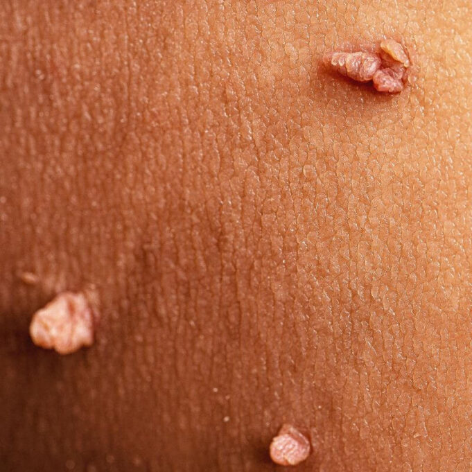 Is There a Skin Tag Removal Toothpaste? Is There a Skin Tag Removal Toothpaste?